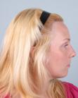After Hair Transplant&nbsp;Hairline